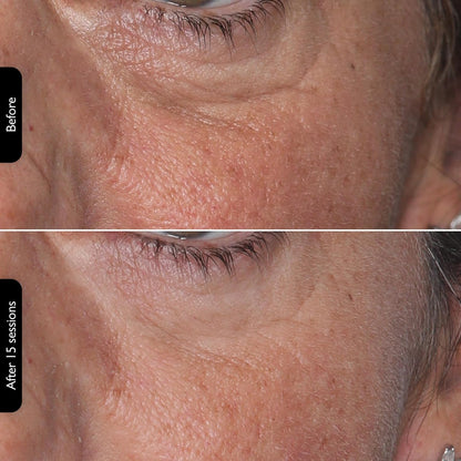 LEDMask | Skin improvement with LED technology