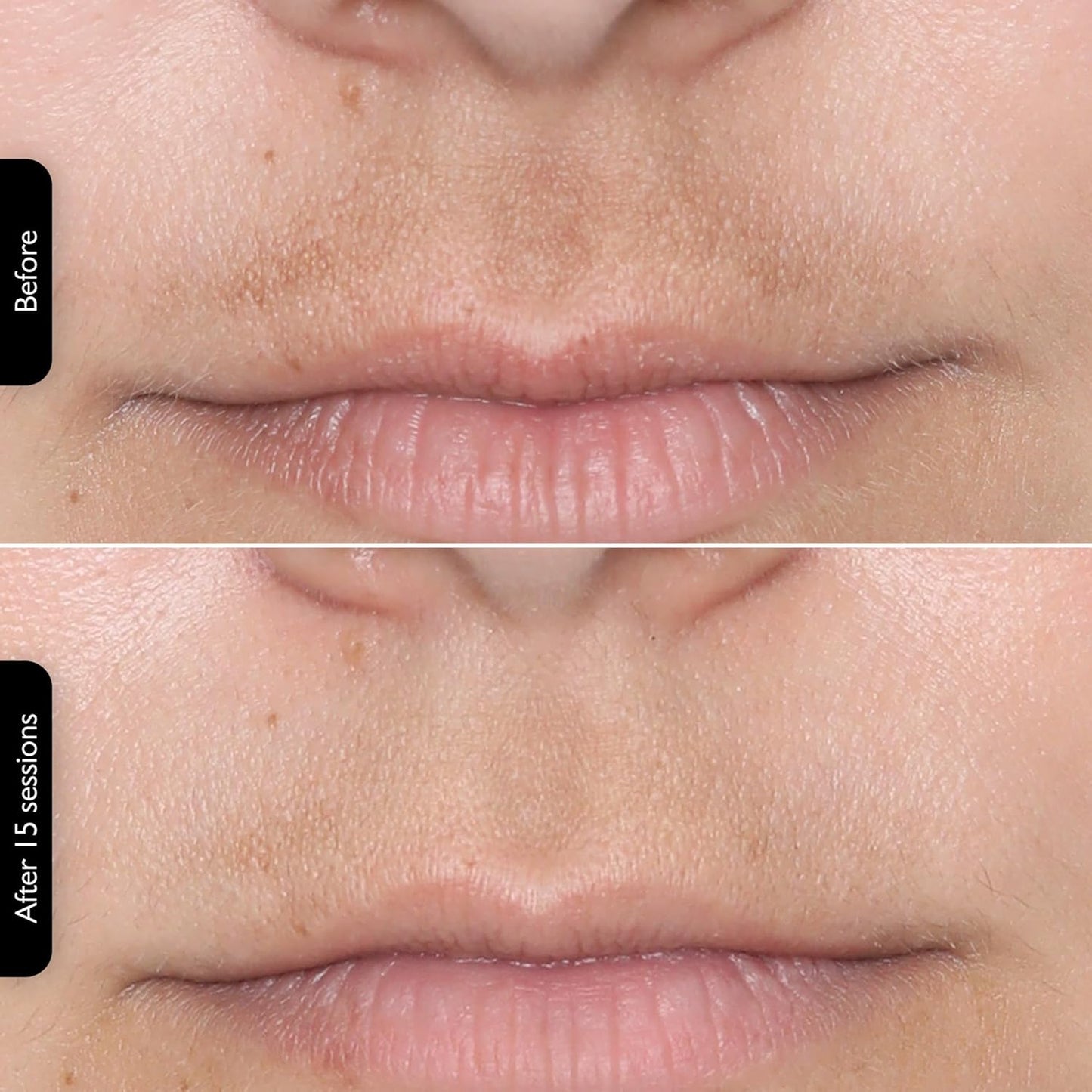 LEDMask | Skin improvement with LED technology