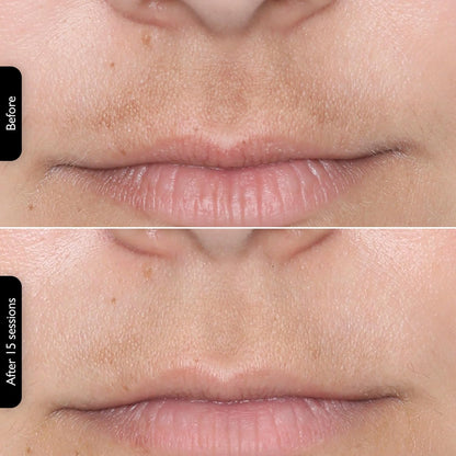 LEDMask | Skin improvement with LED technology